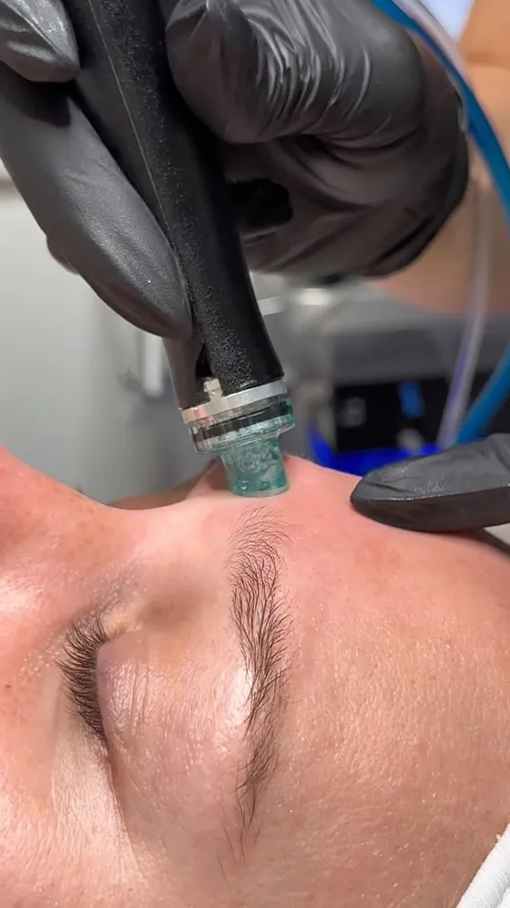 A Hydrafacial in progress at The Self-Care Clinic, Exeter