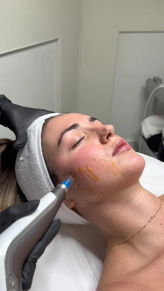 Glowing skin after a microneedling and peel treatment